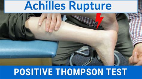 May 24, 2023 · The Thompson test, also known as the calf squeeze test, is a physical examination test used to assess the integrity of the Achilles tendon. The Achilles tendon is the largest and strongest tendon in the body and connects the calf muscles to the heel bone. It is essential for walking, running, jumping, and standing on tiptoes. 